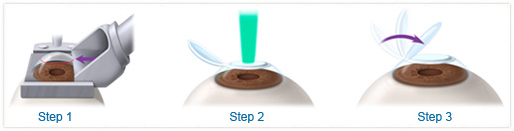 LASIK Eye Surgery Malaysia | Price & Info - ISEC MY LASIK Eye Surgery Malaysia | Price & Info - ISEC MY