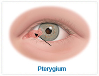 翼状胬肉以及结膜黄斑- INTERNATIONAL SPECIALIST EYE CENTRE MALAYSIA