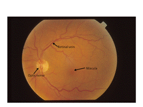 视网膜静脉阻塞 (RVO)第一部分 - INTERNATIONAL SPECIALIST EYE CENTRE MALAYSIA